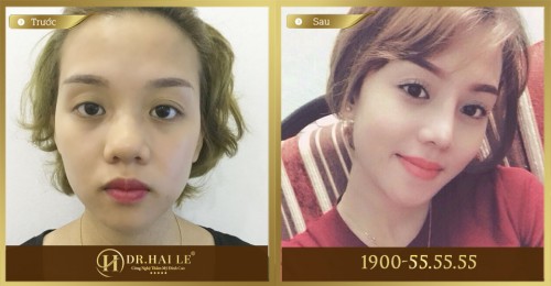 Một khách hàng nâng mũi s line tại Dr Hải Lê
