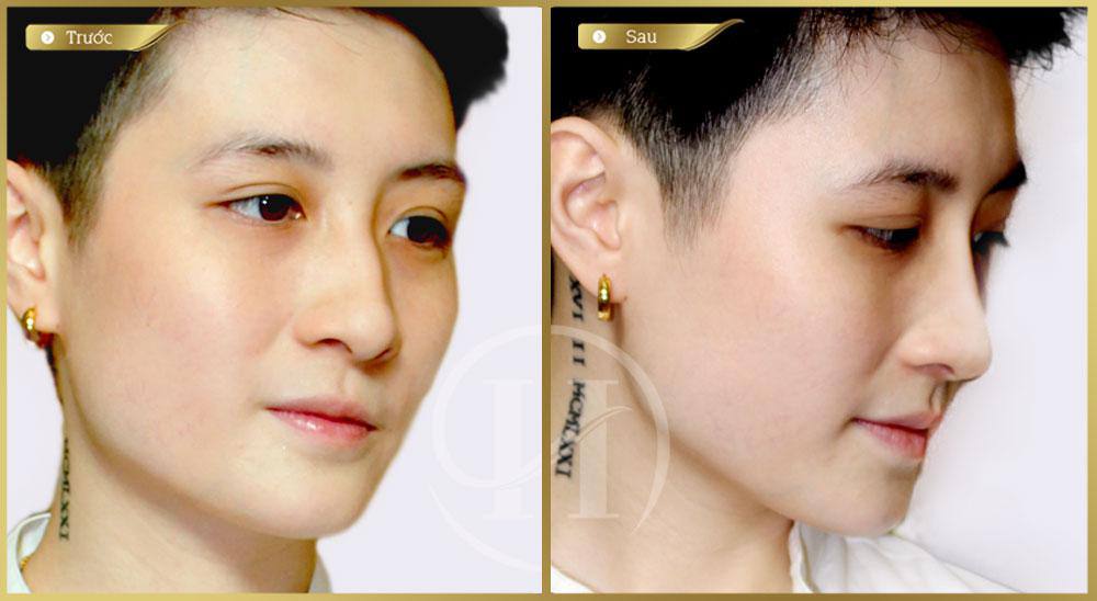 HotFb LinJay nâng mũi L line 2 lớp Double L