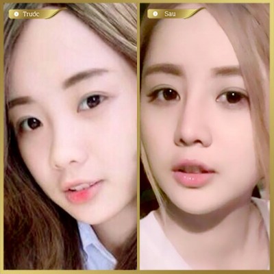 Thu gọn cánh mũi