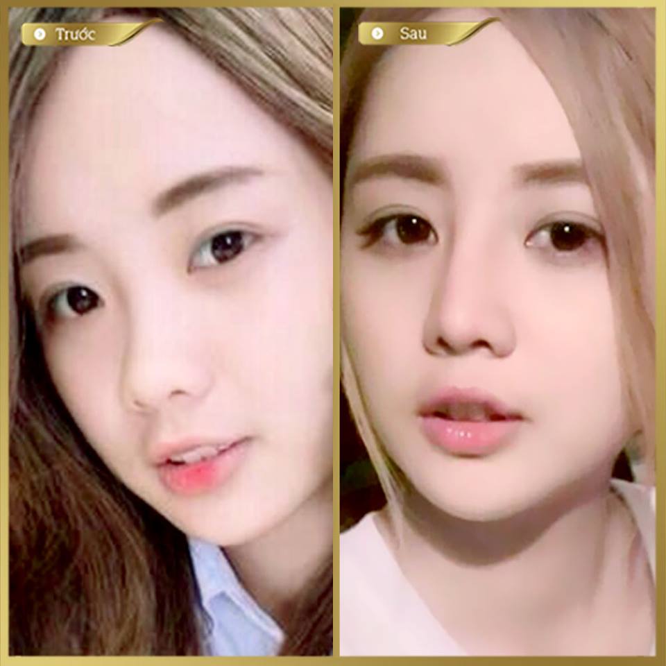 Thu gọn cánh mũi