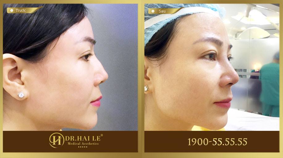 Chị Trang nâng mũi demi 5D