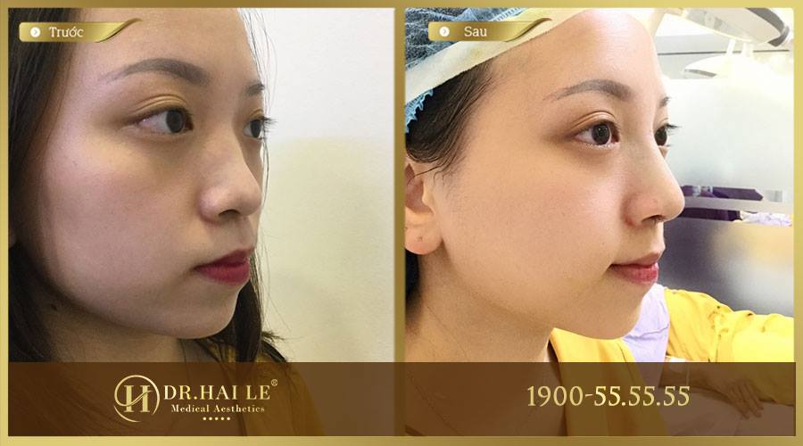 Hình ảnh khách hàng trước và sau khi thực hiện nâng mũi tại Dr.Hải Lê