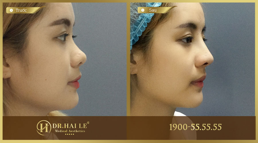 Khách hàng trước và sau khi thực hiện nâng mũi Medi-Form tại Dr.Hải Lê