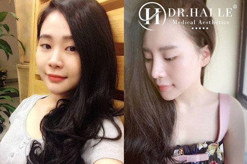 Hình ảnh khách hàng trước và sau khi nâng mũi thẩm mỹ tại Dr.Hải Lê