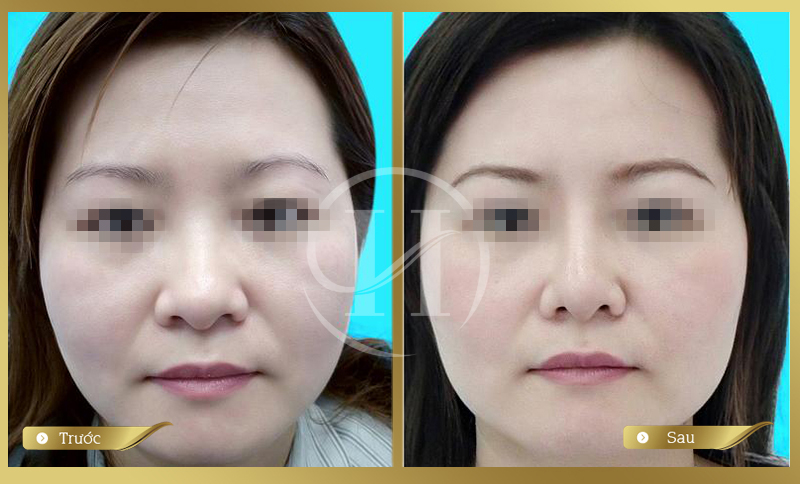 Thu gọn đầu mũi