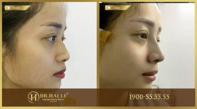 Phẫu thuật sửa mũi gồ