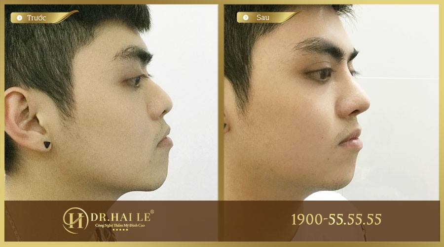 sua-mui-go-phau-thuat