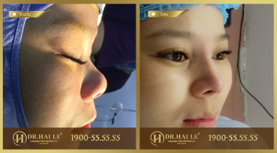 Thu gọn đầu mũi