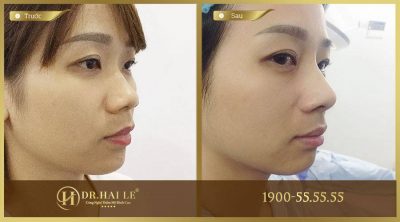 Thu gọn đầu mũi