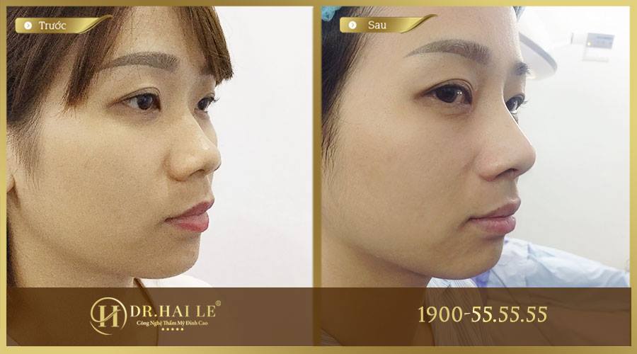 Thu gọn đầu mũi