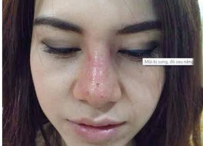 Nâng mũi 1 tháng vẫn còn sưng