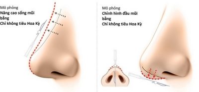 Nâng mũi bằng chỉ giữ được bao lâu 1