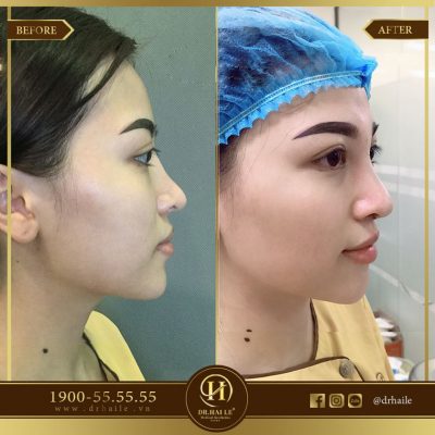 Kẹp nâng mũi có thực sự hiệu quả không 2