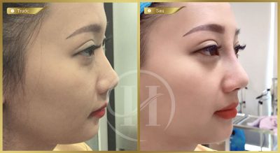 Nâng mũi giá 3 triệu có thực sự tốt không 2