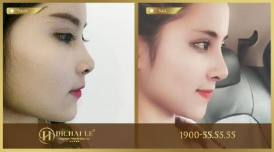 Dụng cụ thu gọn cánh mũi 2