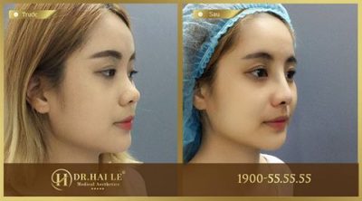 Thẩm mỹ viện nào sửa mũi đẹp nhất