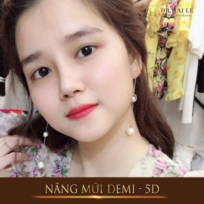Va chạm nhẹ sau khi nâng mũi có sao không 1