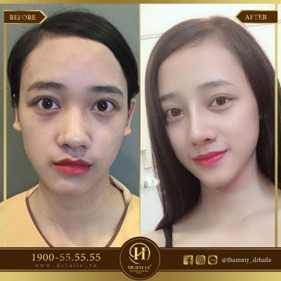 Biến chứng nâng mũi bằng Silicon 2
