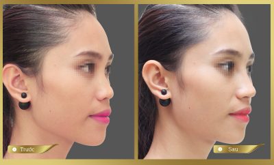 thẩm mỹ viện nà sửa mũi đẹp nhất 2