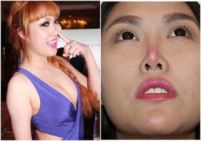 Tại sao không nên phẫu thuật thẩm mỹ 1