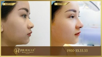 Đầu mũi to tròn