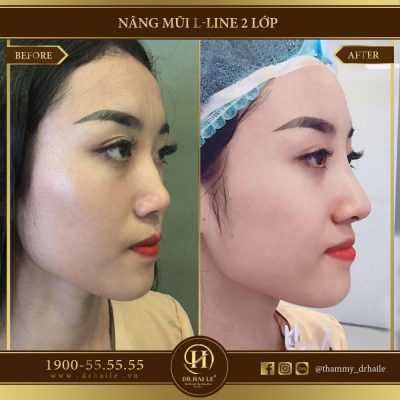 Chỉnh sửa mũi tẹt bằng phương pháp nâng mũi L Line