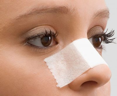 Sau bao lâu tháo nẹp mũi được