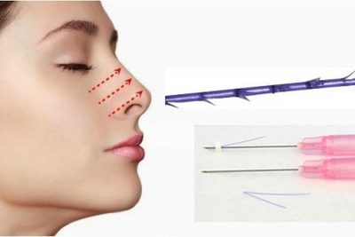 Nâng mũi bằng chỉ Collagen là gì?